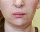 Feel Beautiful - Juvederm in Nasal-labial-folds-San-Diego - After Photo